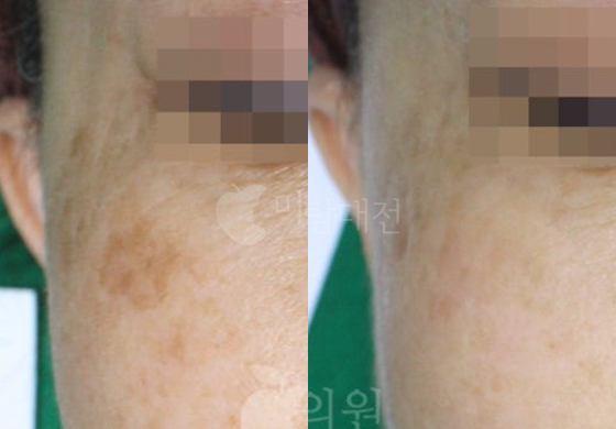 전후사진